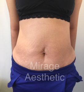 Fat Freeze Before 1 1 3 274x300