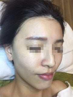 After COLLAGEN 1