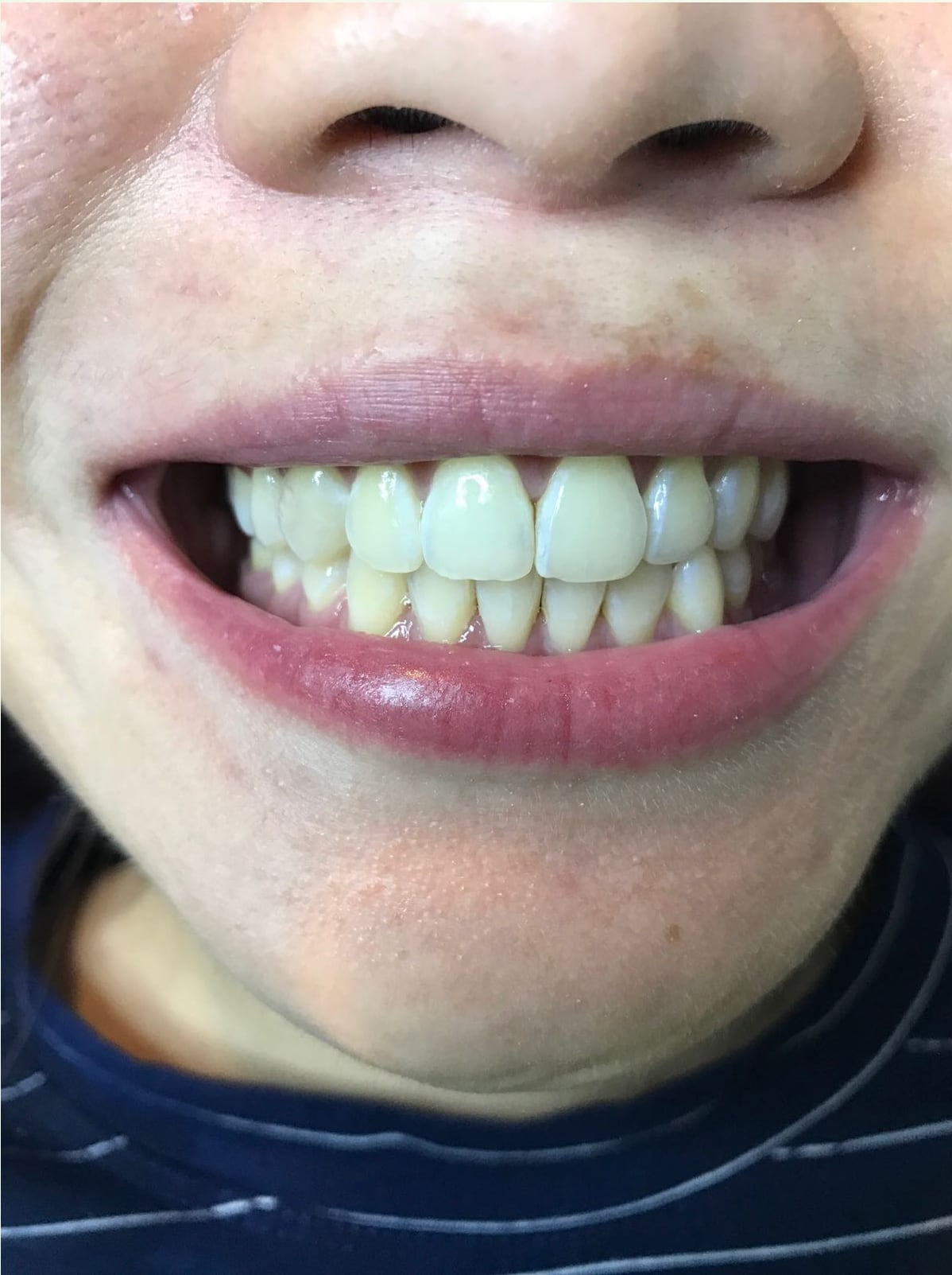 After LED TW 1