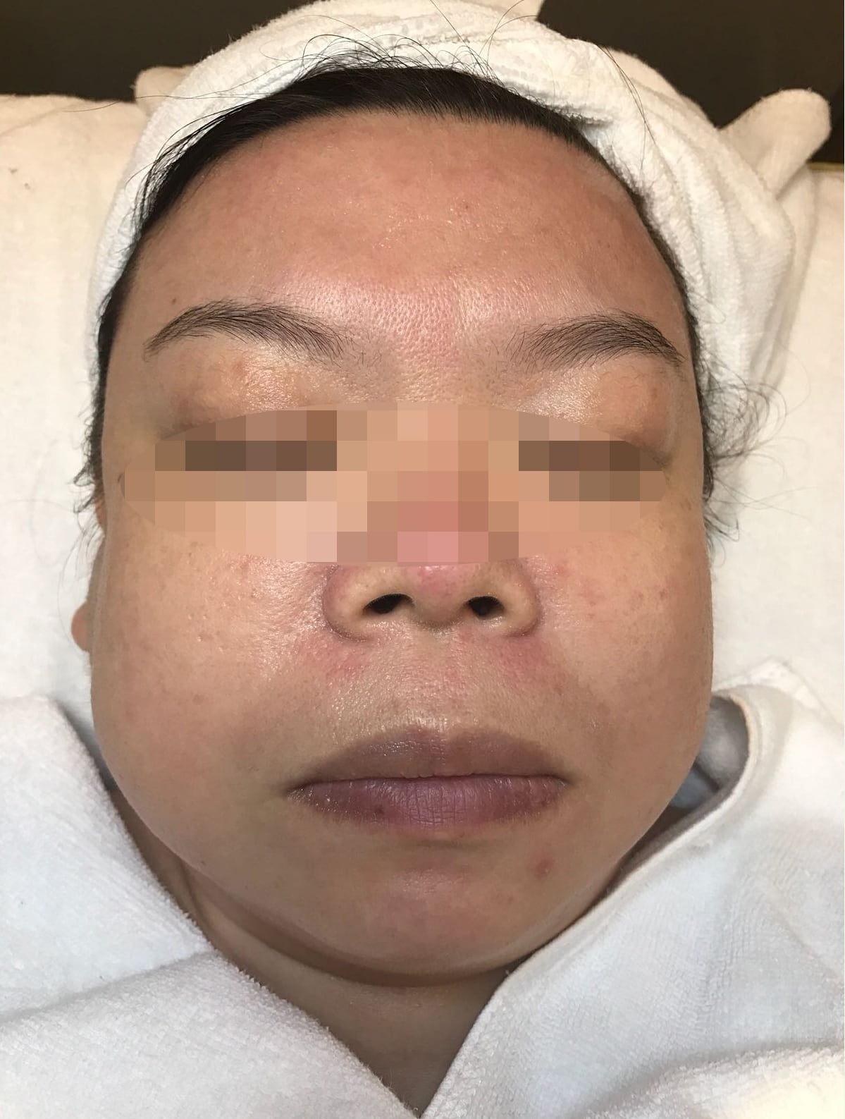 After PIGMENTATION 1