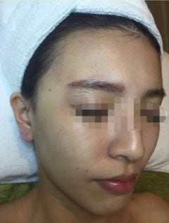 Before COLLAGEN 1