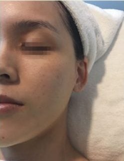 Before COLLAGEN 2