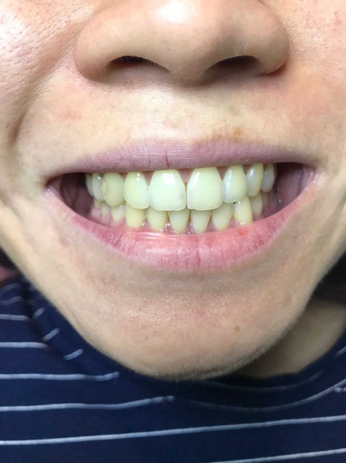 Before LED TW 1