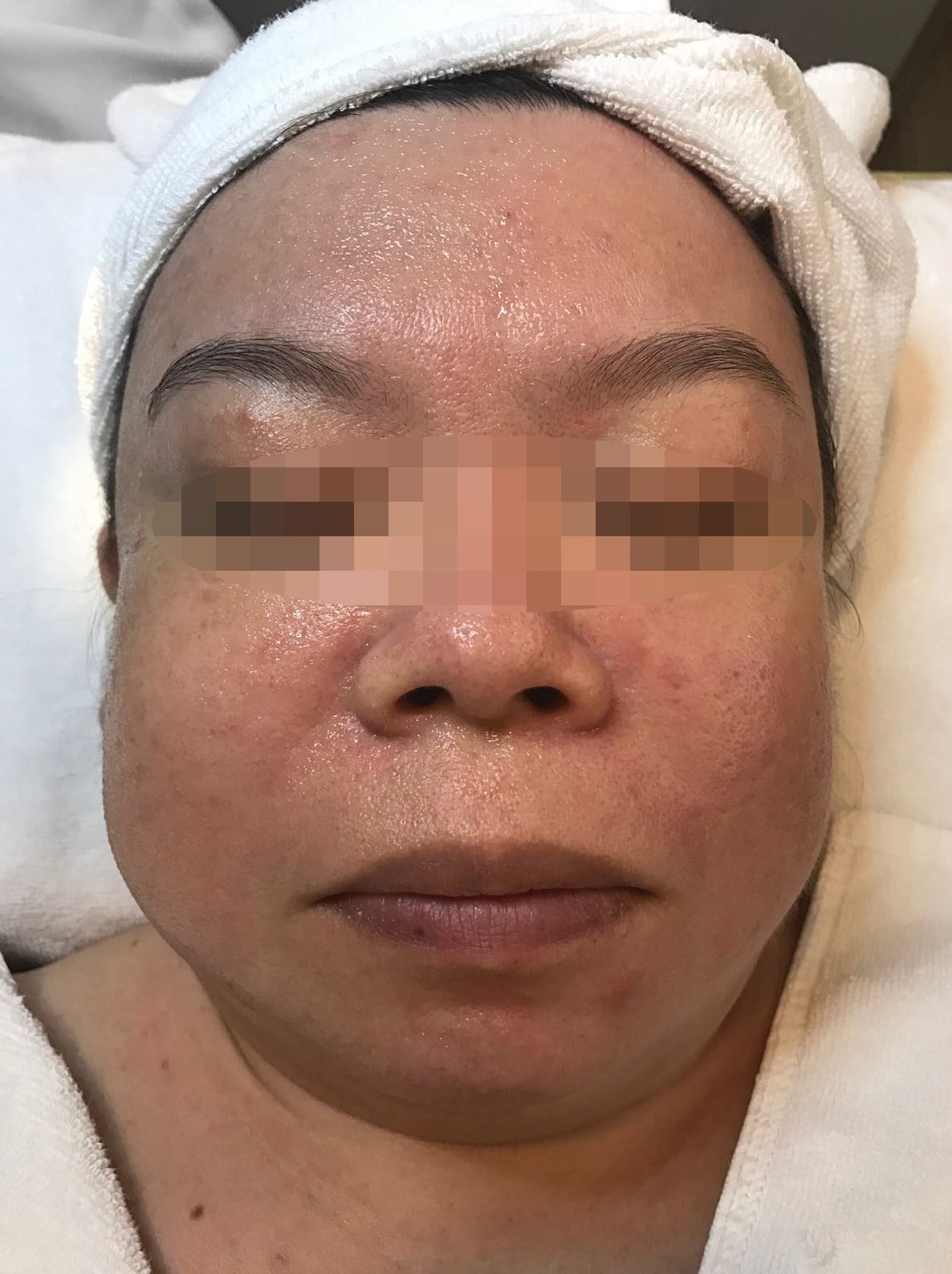 Before PIGMENTATION 1