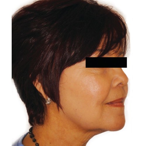 VDP skin tightening 1 after