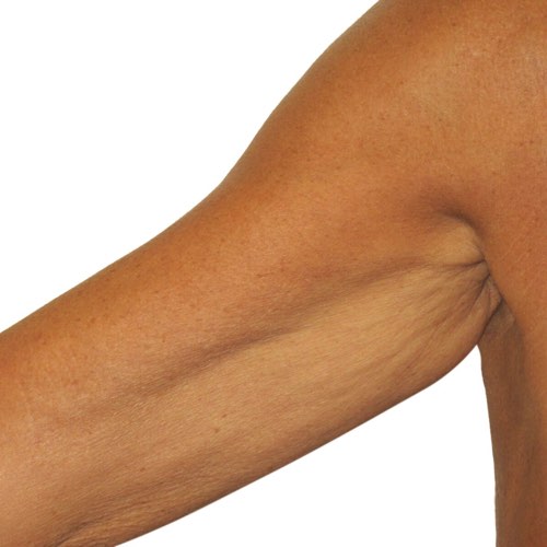 VDP skin tightening 2 after
