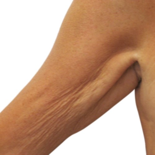 VDP skin tightening 2 before
