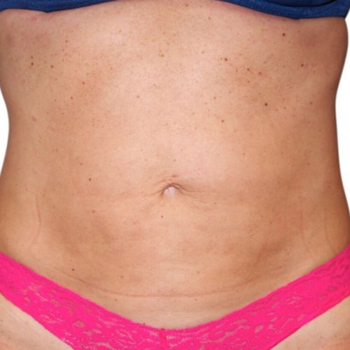 VDP skin tightening 3 after