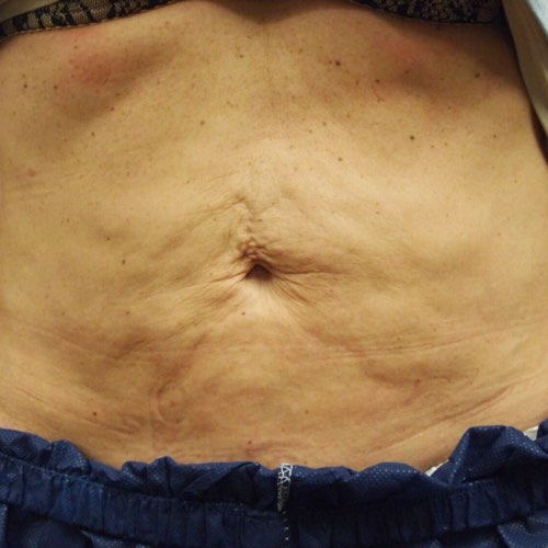 VDP skin tightening 3 before