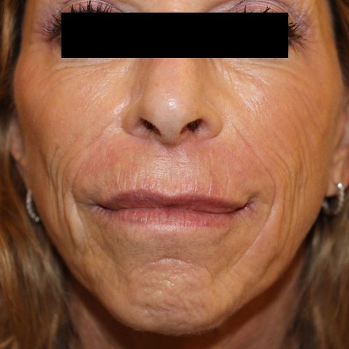 VDP wrinkle reduction 1 before