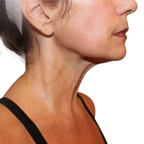 VDP wrinkle reduction 3 after