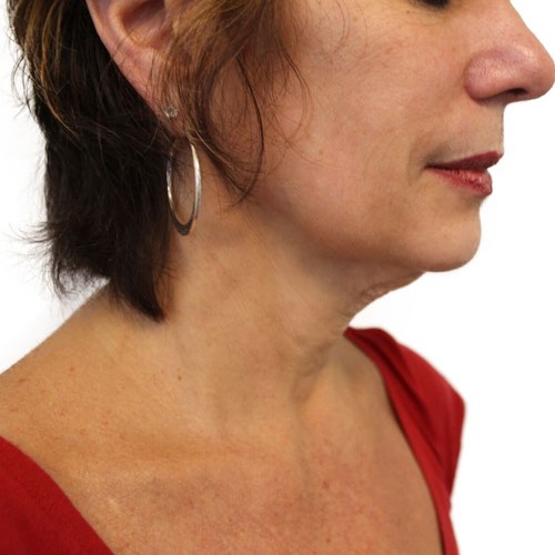 VDP wrinkle reduction 3 before