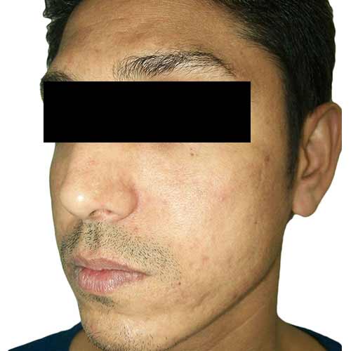 VF acne scar reduction 3 after