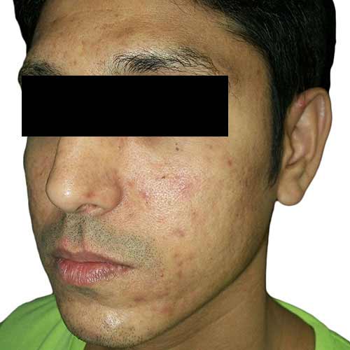 VF acne scar reduction 3 before