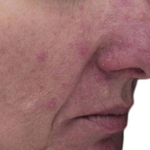 VF rosacea 2 after