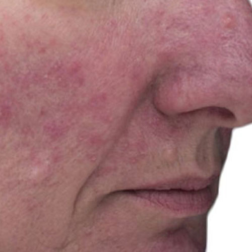 VF rosacea 2 before