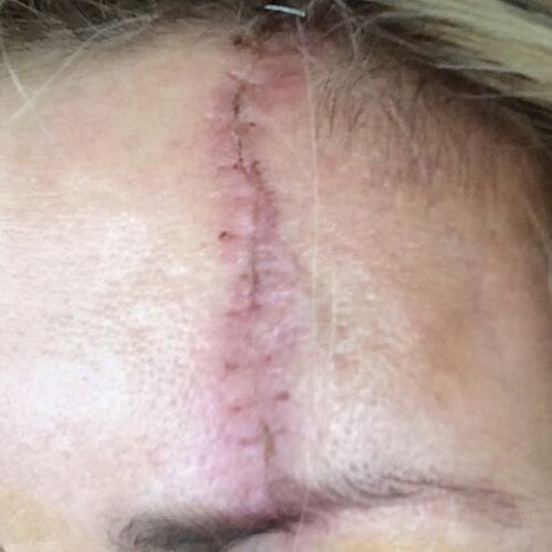 VF venus viva 1 before