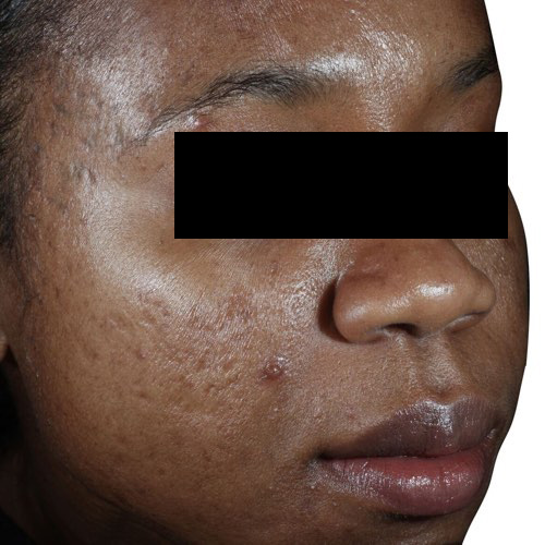 VF venus viva 2 before