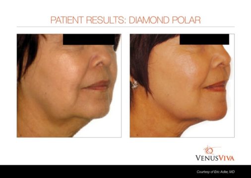skin tightening 1