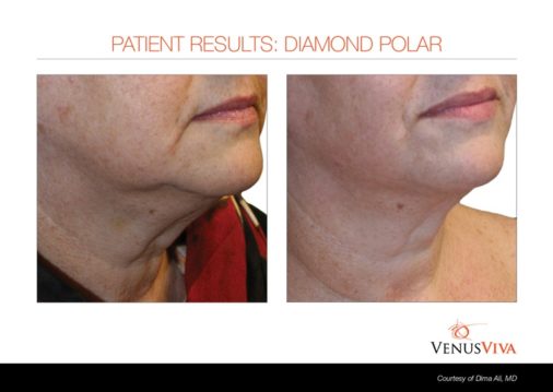 skin tightening ba 1