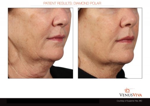 skin tightening2 ba 1