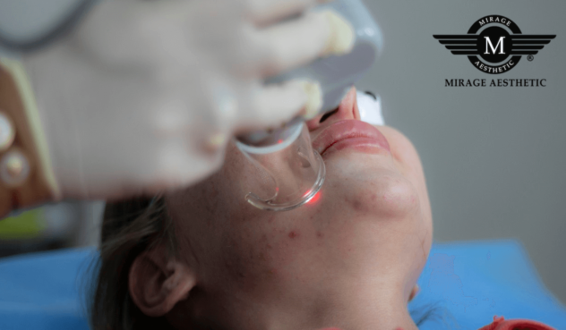 Benefits of Acne Scar Treatment