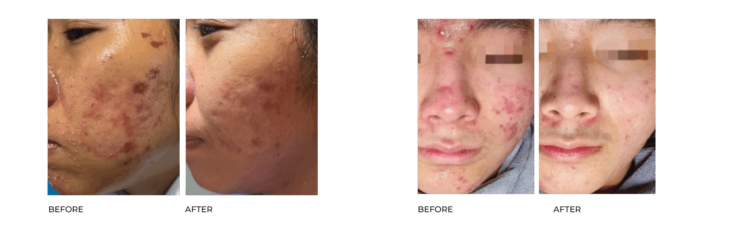 ACNE XPERT BA 25