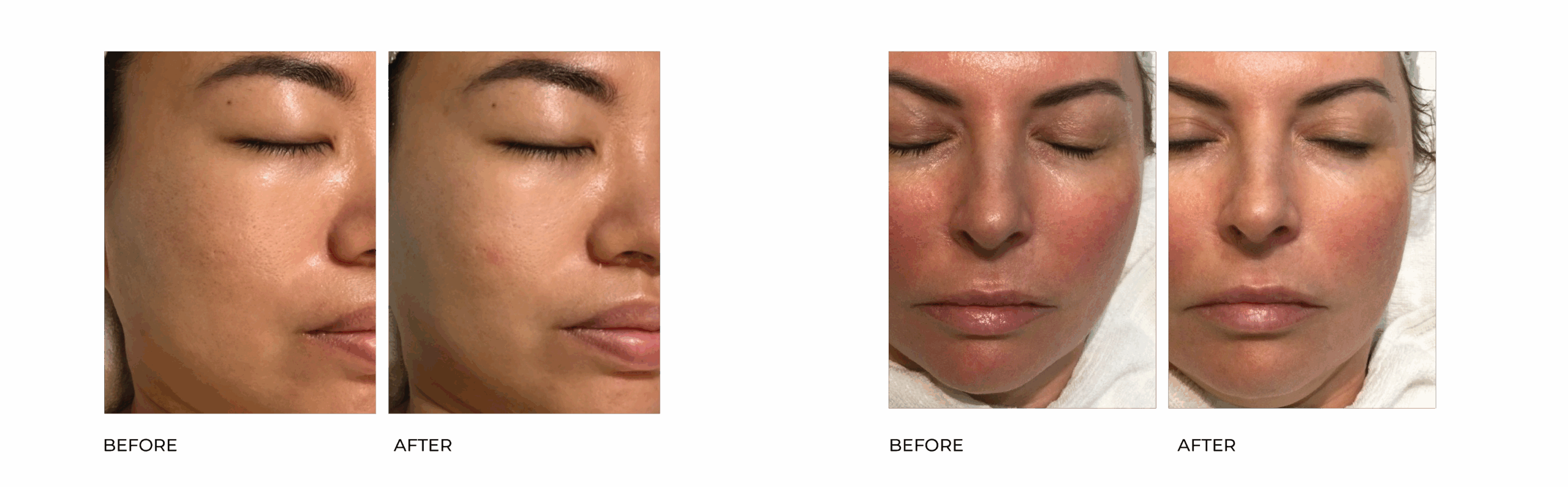 COLLAGEN BA 13