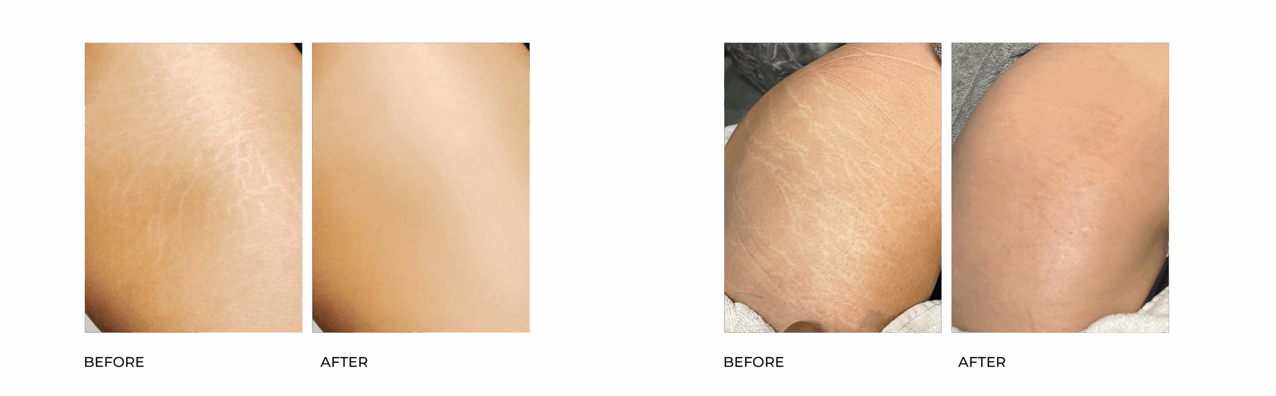 STRETCH MARK BA 07