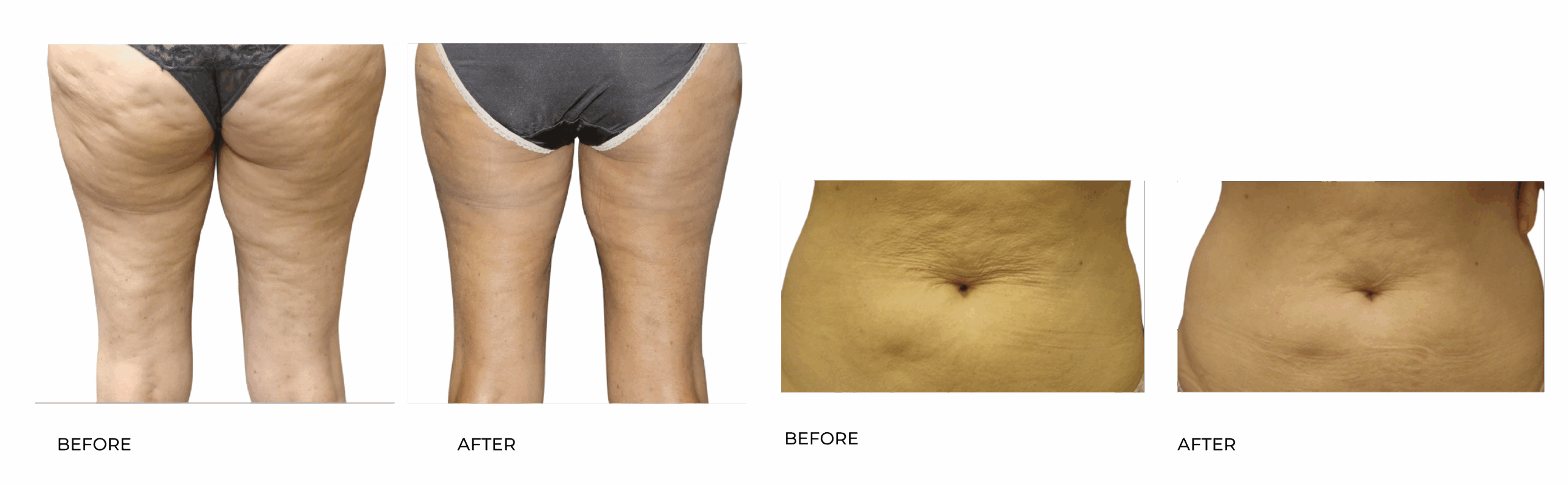 cellulite BA 01 12